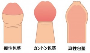 包茎　三種類